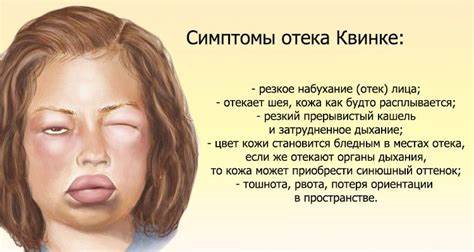 Диета отек квинке крапивница Что такое отек квин Что такое отек квин Диета отек квинке крапивница