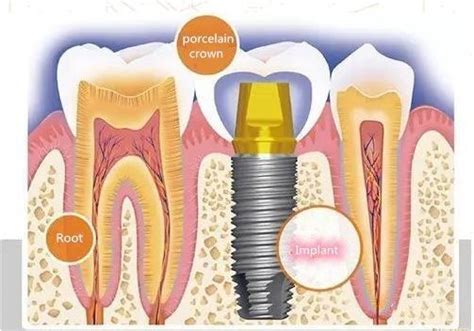Dental insurance covers about 50% of the cost of the crown is needed for dental reasons. why does dental implant cost so much | dental laboratory supply