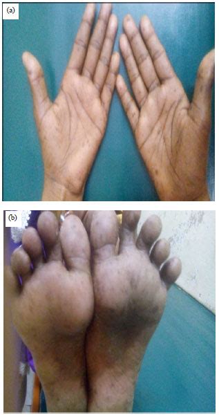 Peutz Jeghers Syndrome In A Child Presenting With Acute Abdomen A Case
