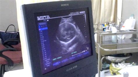 Ada yang 31 hari (januari, maret, mei, juli, agustus, oktober, desember) = 4 minggu lebih 3 hari. Perkembangan Janin 9 Bulan (36 minggu) #BabyG (USG Bayi ...