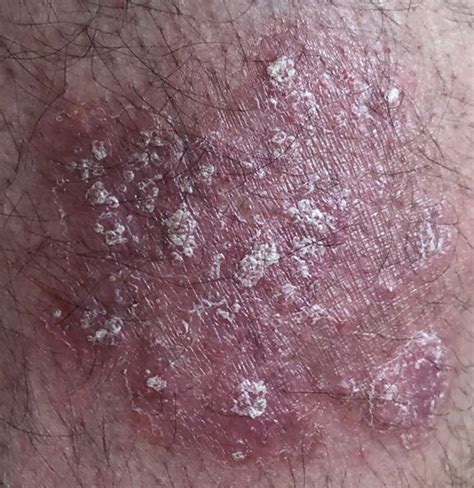 Psoriasis Is Not Contagious What You Need To Know Knysna Plett Herald