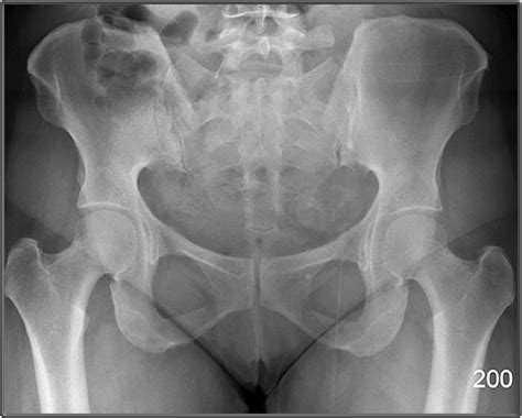 Systematic review three rings trace the main pelvic ring and two obturator foramina if a ring is disrupted, think fracture pelvis xr. Pelvic X Ray Anatomy