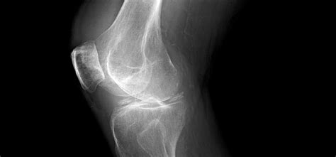 Knee Fracture Treatment Management And Prevention