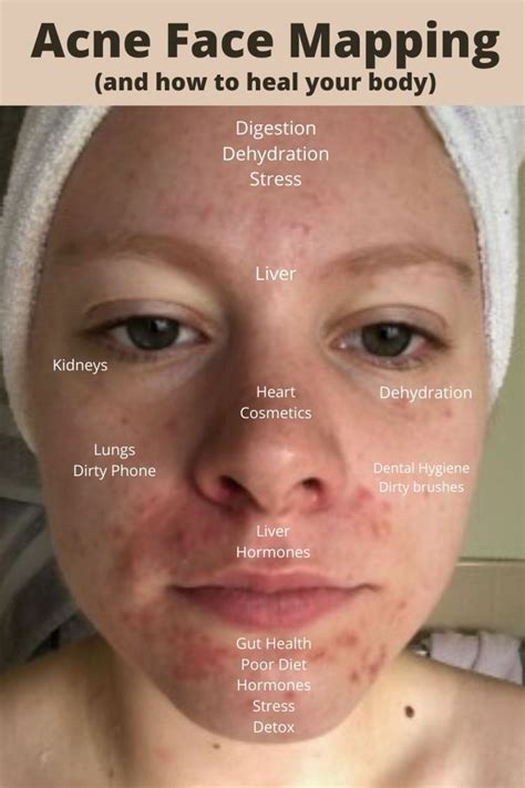 Face Mapping What Your Acne Is Saying About Your Health Simply Noel