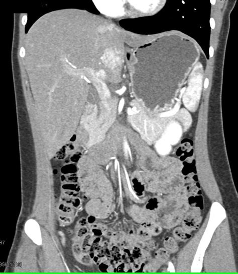 Multiple Focal Nodular Hyperplasia Fnh In The Liver Liver Case