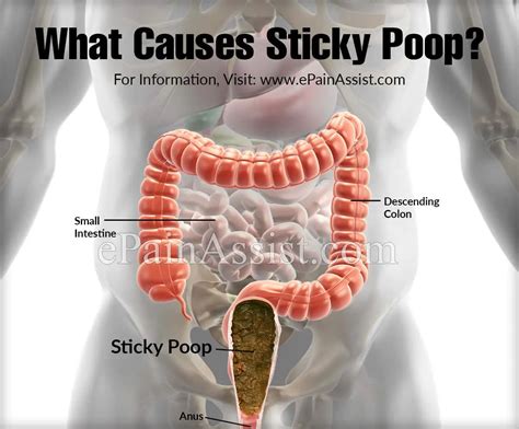 What Causes Sticky Poop And What To Do About It