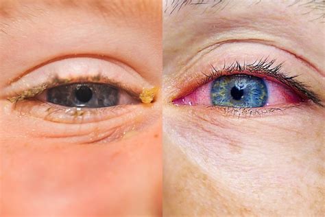 Allergies Or Pink Eye Heres How To Tell The Difference Readers Digest