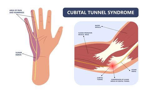 Cubital Tunnel Syndrome Nerve Impingement