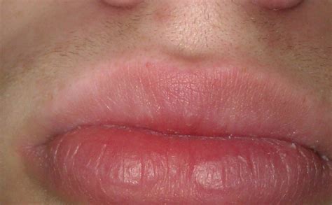 My Progress So Far A Long Read At Peeling Lips Exfoliative Cheilitis