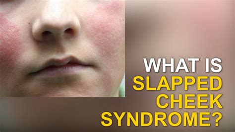 Slapped Cheek Syndrome Can Be Dangerous But Here S What You Need To Look Out For Kent Live