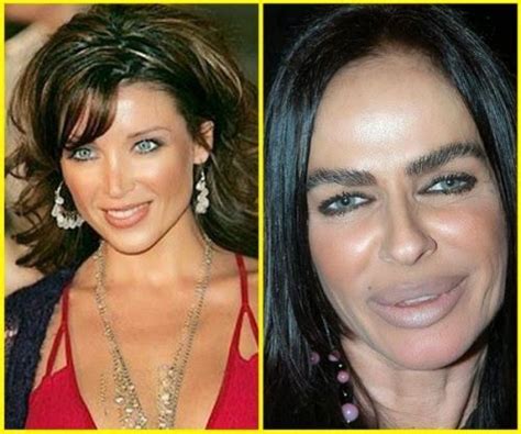 Plastic Surgery Disasters Before And After Pictures