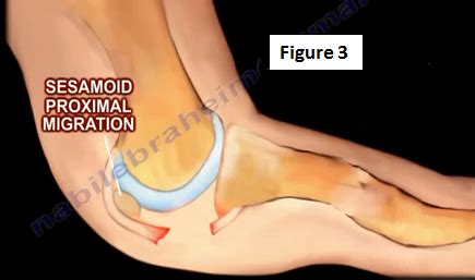 By sports podiatrist and runner stephen pribut, d.p.m. Turf Toe | HuffPost