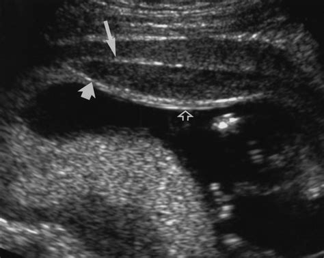 Hemorrhage During Pregnancy Sonography And Mr Imaging Ajr