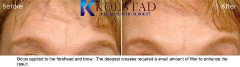 Botox And Filler Forehead Wrinkles Smooth Natural Results San Diego La
