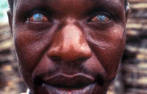 A Man 30 40 Years Old Blind Due To Onchocerciasis Flickr