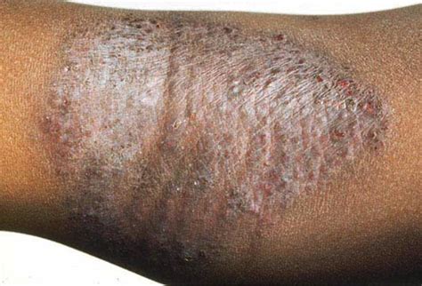 Following the incubation period, one or more lesions may appear. Herpes Cure Page 73