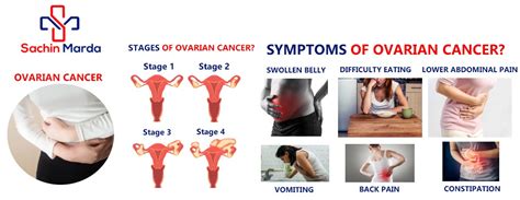 Ovarian Cancer Symptoms Stagesdiagnosis Sachin Marda Best Cancer