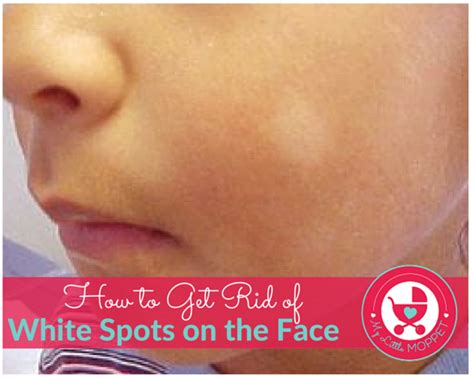 5 Ways To Get Rid Of White Spots On The Face Of Your Child White Skin