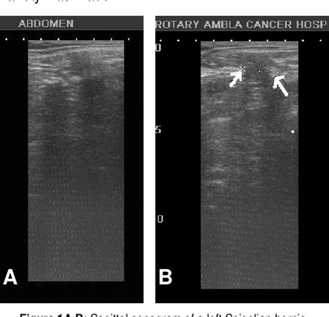Figure 1 From Left Lower Quadrant Acute Abdominal Pain A Case Of