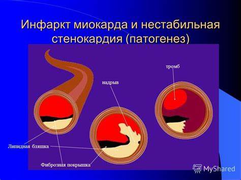 Нестабильная стенокардия диета Презентация на тему: "Острый коронарный синдром. Нестабильная Презентация на тему: "Острый коронарный синдром. Нестабильная Нестабильная стенокардия диета