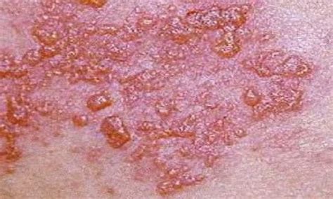 Shingles Signs And Symptoms