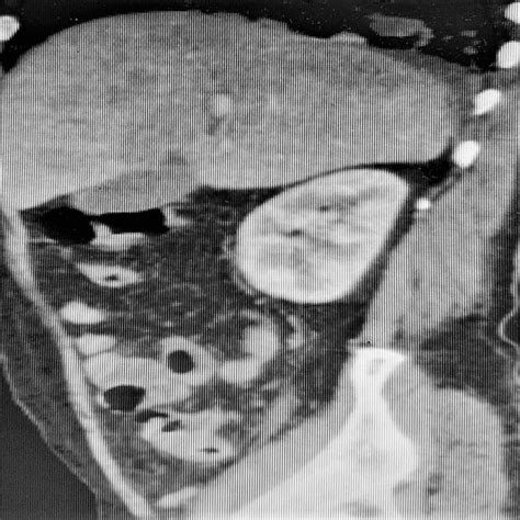 Ct Thorax Showing Multiple Heterogeneous Nodular And Soft Tissue