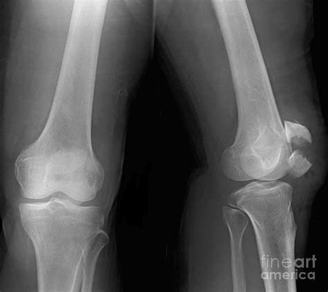Broken Knee Cap Photograph By Rajaaisyascience Photo Library Fine