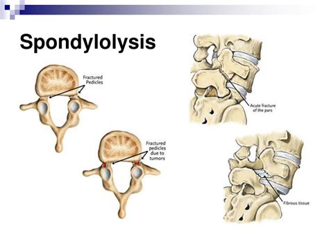 Ppt Exercises For The Spine Powerpoint Presentation Id169396