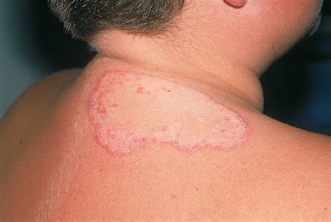 Fungal Skin Infection Of Many Colors Tinea Versicolor Sexiz Pix