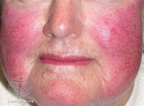 Persistent Facial Erythema Red Face Medicine Medicaltalknet