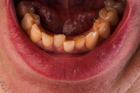 Oral Cancer Overview Causes Symptoms Treatment