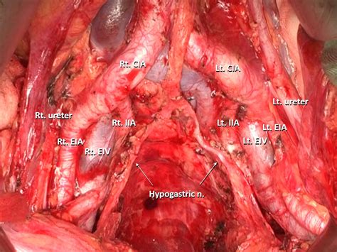 Lateral Pelvic Lymph Node Dissection For Low Rectal Cancer My Xxx Hot
