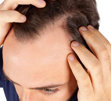 Understanding Why Men Lose Hair And What Can You Do To Prevent It The Manliness Kit