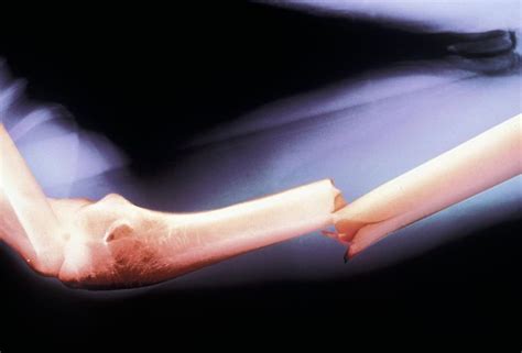 Humeral Shaft Fractures Causes Diagnosis Treatment Health Rxharun