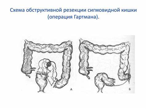 Стома сигмовидной кишки диета Рак Прямой Кишки Операция Стома Рак Прямой Кишки Операция Стома Стома сигмовидной кишки диета