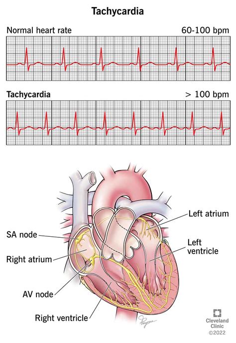 Tachycardia Symptoms Causes And Treatment