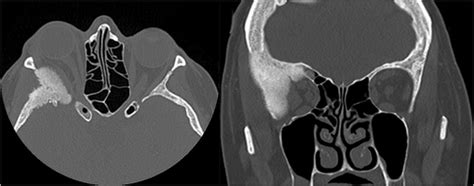 Preoperative Thin Bone Window Ct Sections Of An External Som Variety