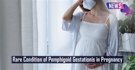 Pemphigoid Gestationis In A Pregnant Woman Medsynapse