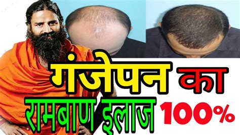 Baba ramdev's hair loss treatment includes the divya tejus tailum oil that is prepared out of medicinal herbs, is very beneficial in maintenance of natural skin and helps in hair care. hair fall and alopecia ayurvedic treatment for male and ...