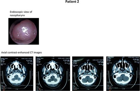 Endoscopic And Ct Images Of Patient 2 Endoscopic Pictures Through The