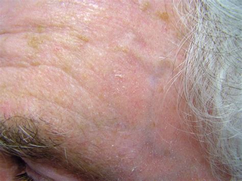 Actinic Keratosis Pictures