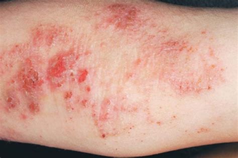 What It S Like To Live With Severe Eczema The Healthy