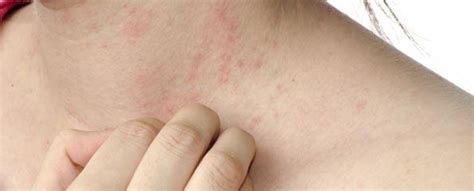 Allergy Atopic Dermatitis Eczema Rash Information Myvmc