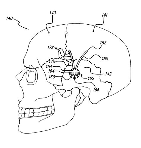 Patent Us8401634 Treatment Of Movement Disorders By Brain Stimulation