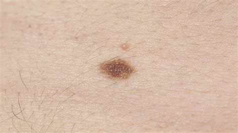 Melanoma Symptoms How To Spot Signs And When To See A Doctor