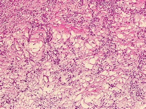 Pathology Outlines Angiofibroma Of Soft Tissue