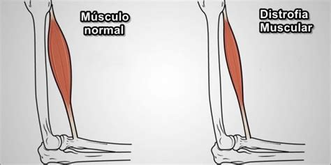 Distrofia Muscular O que é Sintomas e Tratamentos Dicas de Musculação