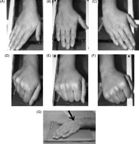 Positioning Of The Wrist For Scaphoid Radiography European Journal Of