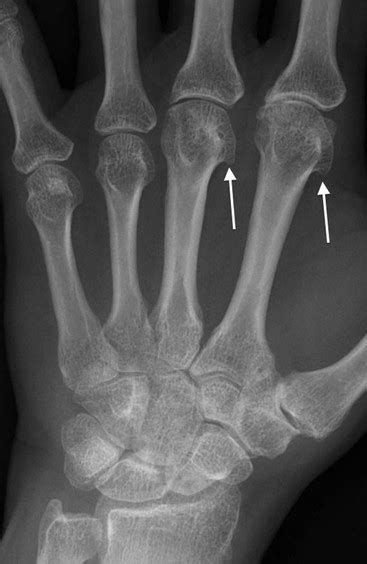 Arthritis Radiology Key