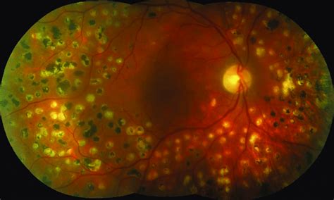 Initial Fundus Photography Of Right Eye Stable Retinal Periphery After